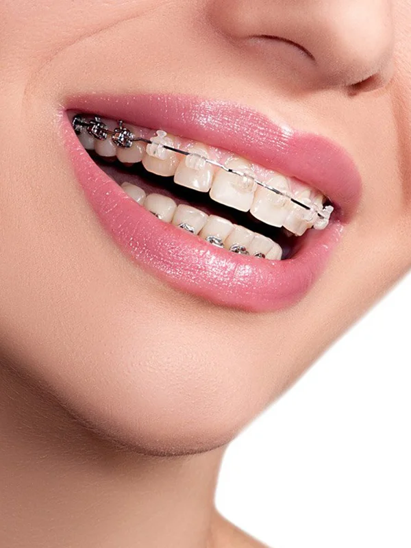 px-تقويم-الأسنان